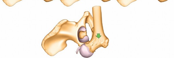 Illustration 26 for Acetabulum Posterior Approach: Simplest Fix for Hip Fractures