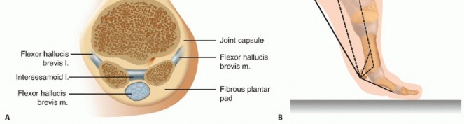 Illustration 2 for Optimizing Internal Fixation of Sesamoid Fractures