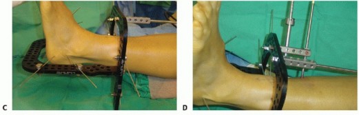 Illustration 60 for Mastering Midfoot Arthrodesis: Protect the Deep Neurovascular Bundle