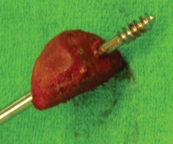 Illustration 7 for Expert Bone Grafting for Primary Total Hip Replacement Success