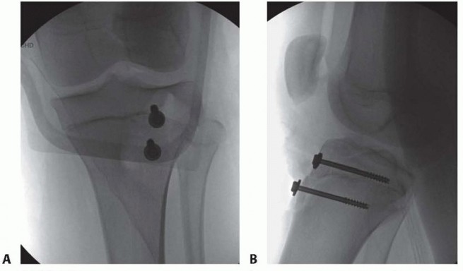 Illustration of tibial tuberosity fractures - Dr. Mohammed Hutaif