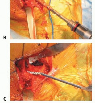Illustration 33 for Hemiarthroplasty of the Hip: Indications & Types Explained