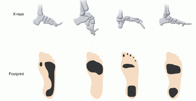 Illustration 2 for How Achilles Tendon Lengthening Fixes Equinocavovarus Foot