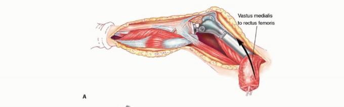 Illustration 50 for Mastering Femoral Metastases: Optimal Function for Femoris & Vastus