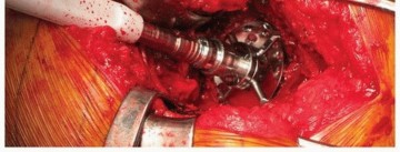 Illustration 21 for Uncemented Acetabular Revision: Optimizing Hemispherical Cup Use