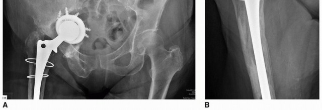 Illustration 15 for Sliding Trochanteric Osteotomy: Modern Role & Refined Techniques