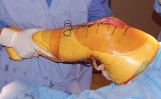 Illustration 45 for Mastering Gap Balancing in Revision TKA: Avoid Common Pitfalls