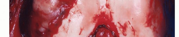 Illustration 13 for Precision Biopsy of Musculoskeletal Tumors for Accurate Diagnosis