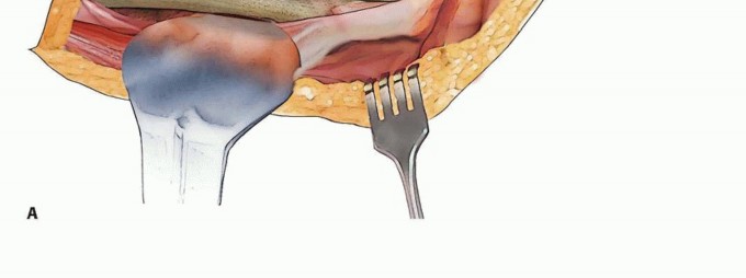 Illustration 6 for Well-Fixed THA Revisions: Precision in the Portion of the Osteotomy