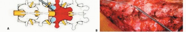 Illustration 15 for Total En Bloc Spondylectomy: Complete Resection for Spinal Tumors