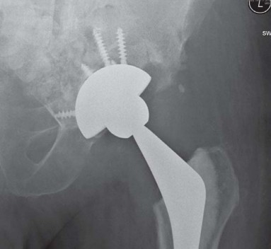 Illustration 36 for Management of Periprosthetic Fractures: An Expert Surgical Guide