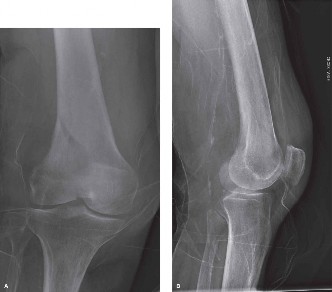 A Distal Femur Case: Mastering Fracture Evaluation