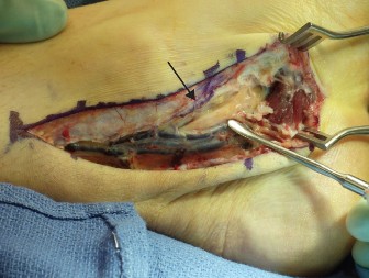 Illustration 2 for Flexor Hallucis Longus: Unlock Your Ankle Pain Mystery & Get Relief