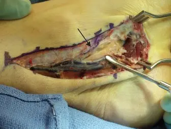 التهاب وتر الإبهام الطويل القابض: دليل شامل من الأستاذ الدكتور محمد هطيف