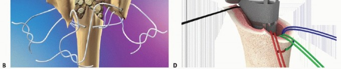 Illustration 31 for Hemiarthroplasty for Proximal: Effective Treatment for Fractures