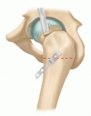 Flexion Intertrochanteric Osteotomy: Realigning Severe SCFE Hips