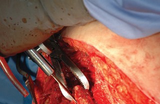 Illustration 75 for Femoral Stem Revision: Posterior Approach for Better Outcomes