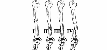 Mastering Type IV Fractures: Essential Periprosthetic Strategies