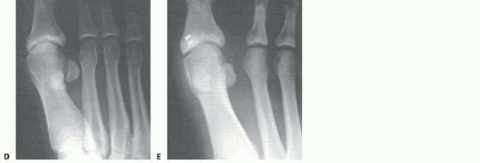 Illustration 24 for Restore Your Foot: Surgical Treatment for Hallux MP Joint Turf Toe