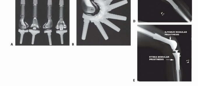 Illustration 13 for Distal Femoral Replacement: Key to Modern Limb Salvage