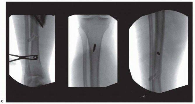 Illustration 25 for Tibia External Fixation: See How Pins Are Placed for Healing