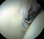 Illustration 28 for Solving Hip Soft Tissue Pathology with Advanced Arthroscopy