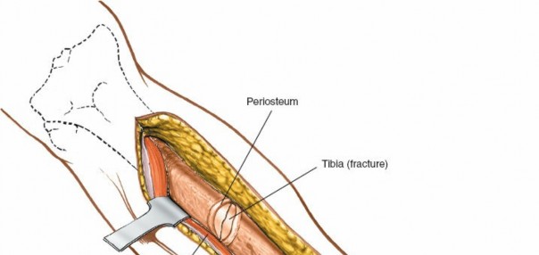 Illustration 63 for Surgical Access: Mastering the Tibia's Surface & Fibula Approaches