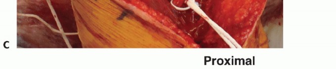 Illustration 19 for Surgical Approaches to Shoulder & Elbow: Pearls and Pitfalls