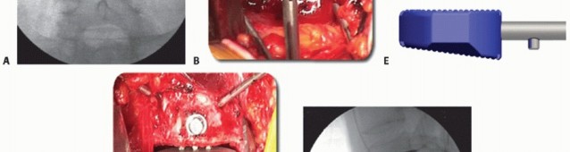 Illustration 15 for Anterior Lumbar Interbody: Fusion, Disc Replacement & Pain Relief