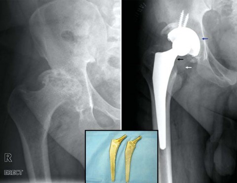 Illustration 17 for Maximize Success: Preoperative planning in primary Hip Replacement