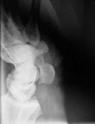 Unlock Wrist Diagnosis: Cases Guided by Figure Sunil Thirkannad