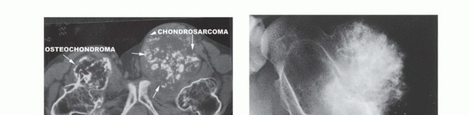 Illustration 43 for Understanding Benign Bone Tumors: Your Complete Preoperative Guide