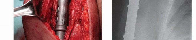 Illustration 24 for Restore Vital Function: Surgery for Type II Humeral Metastasis