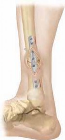 Illustration 10 for Pediatric Tibial Fractures: Avoid Mistakes, Ensure Optimal Healing