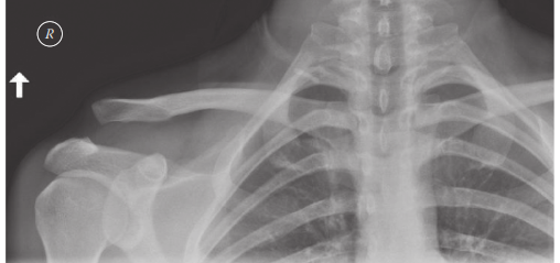 Acromioclavicular (AC) Joint Injuries: Epidemiology, Anatomy, Rockwood Classification & Management