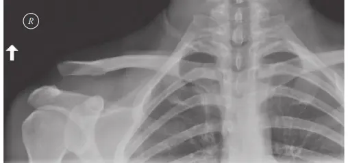 إصابات مفصل الترقوة الأخرمي (AC Joint): دليلك الشامل للتشخيص والعلاج في صنعاء مع الأستاذ الدكتور محمد هطيف