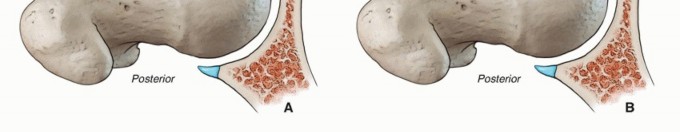 Illustration 6 for Hip Arthroscopy: Your Minimally Invasive Solution for Hip Pain