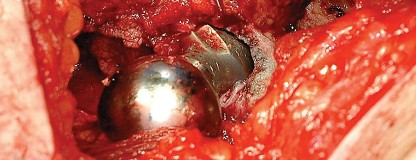 Illustration 13 for Femoral Stem Revision: Posterior Approach for Better Outcomes