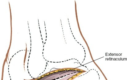 Illustration 103 for Optimized Approaches to the Dorsum of the Foot & Ankle