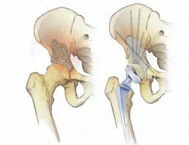 Illustration 6 for Regain Mobility: Total Hip Arthroplasty for Malignant Lesions