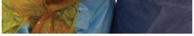 Illustration 15 for Radial Head & Neck Fractures: Mastering ORIF for Best Results