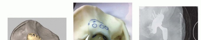Illustration 10 for Pelvic Discontinuity: Understanding Superior and Inferior Separation
