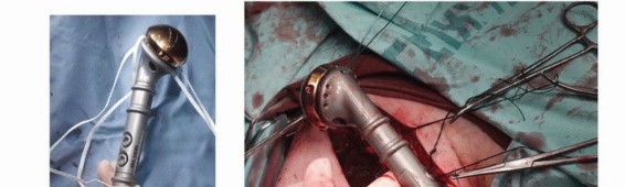 Illustration 31 for Restore Vital Function: Surgery for Type II Humeral Metastasis