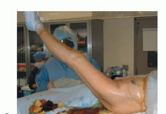 Illustration 22 for Hemiarthroplasty of the Hip: Indications & Types Explained