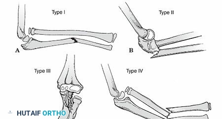 Pediatric Forearm Fractures: Your Guide to Long Arm Casts