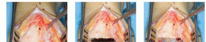 Illustration 21 for HINTEGRA Total Ankle: Unlocking Natural Ankle Movement