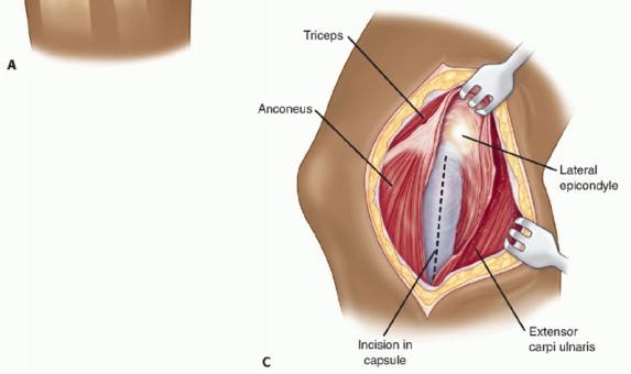 Illustration 51 for Surgical Approaches to Shoulder & Elbow: Pearls and Pitfalls