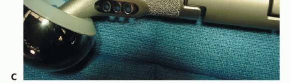 Illustration 7 for Mastering Hip Disarticulation: Through the Hip Joint Capsule