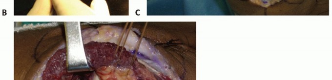 Illustration 35 for Radial Head & Neck Fractures: Mastering ORIF for Best Results