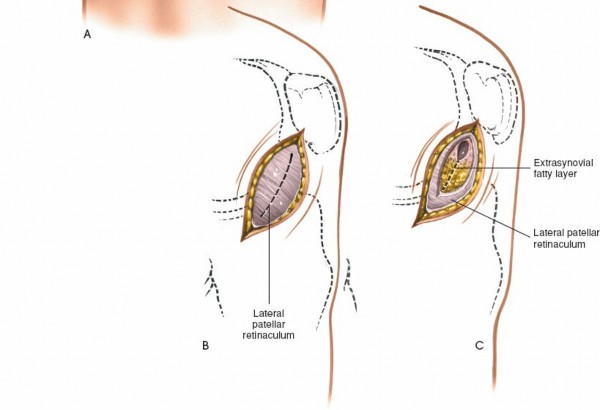 Illustration 138 for Mastering Knee Approaches: Spotlight on Superficial Medial Ligament